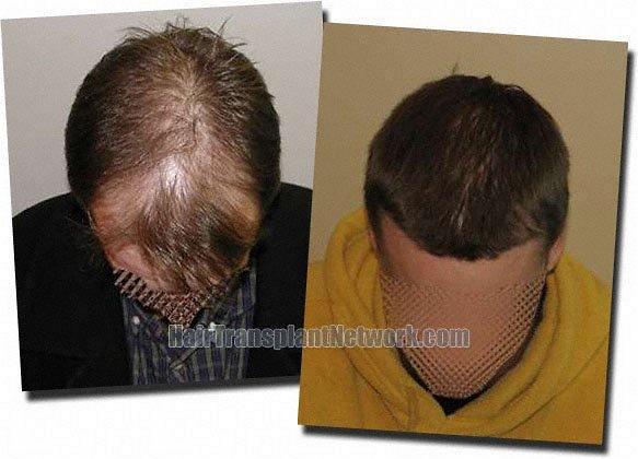 Hair restoration procedure results