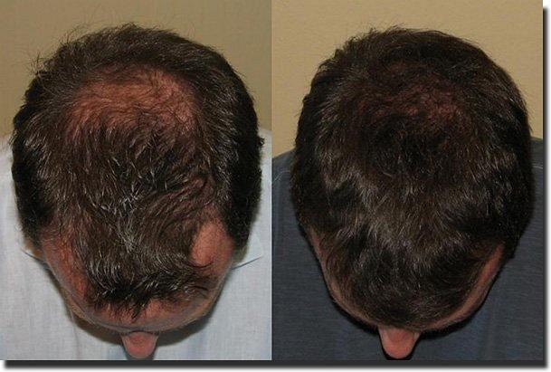 Hair restoration procedure results