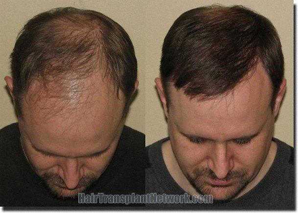 Hair restoration procedure results