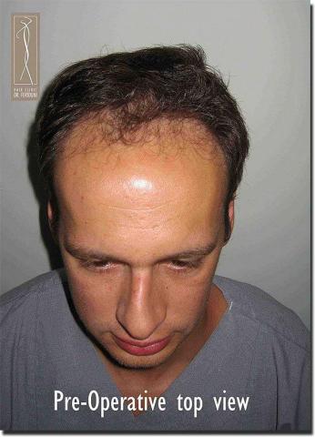 Hair restoration procedure results