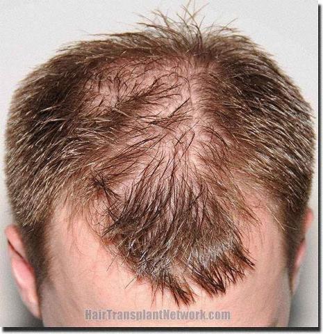 Hair restoration procedure results