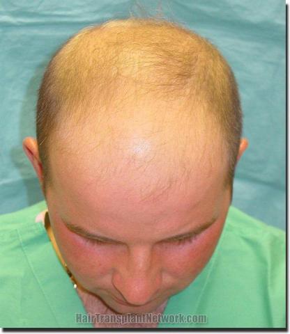 Hair restoration procedure results