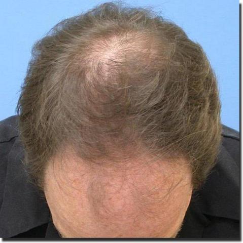 Hair restoration procedure results