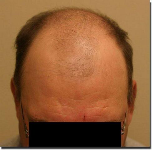 Hair restoration procedure results