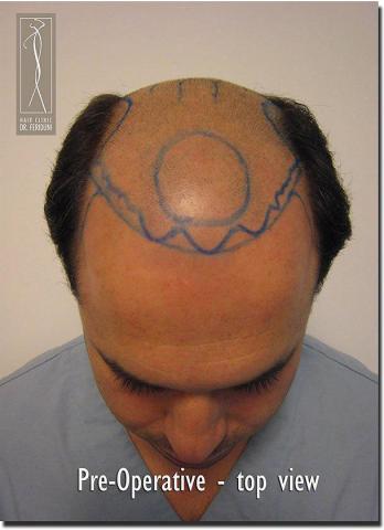 Hair restoration procedure results