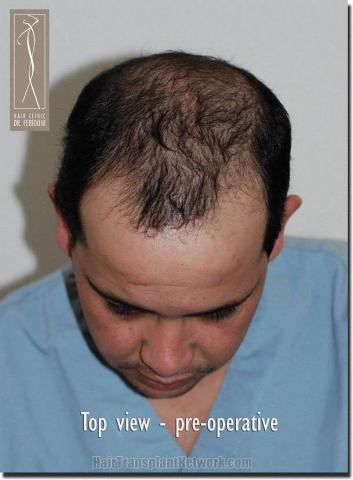 Hair restoration procedure results