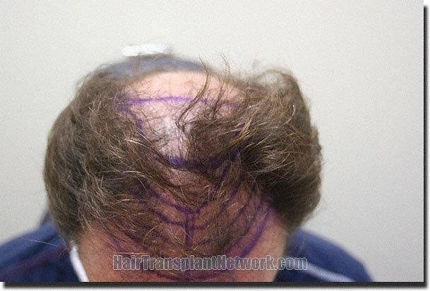 Hair restoration procedure results