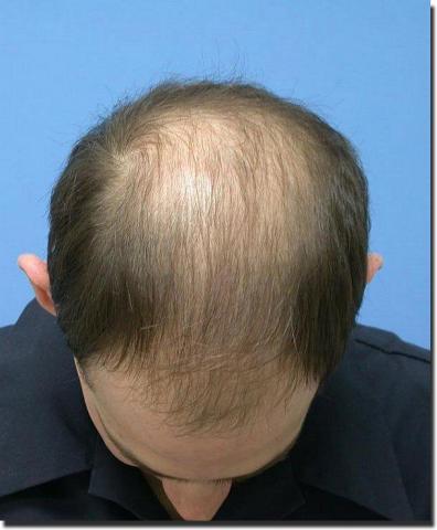 Hair restoration procedure results