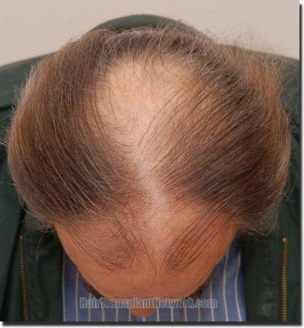 Hair restoration procedure results