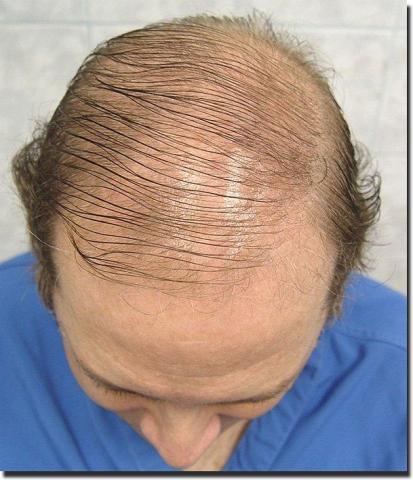 Hair restoration procedure results