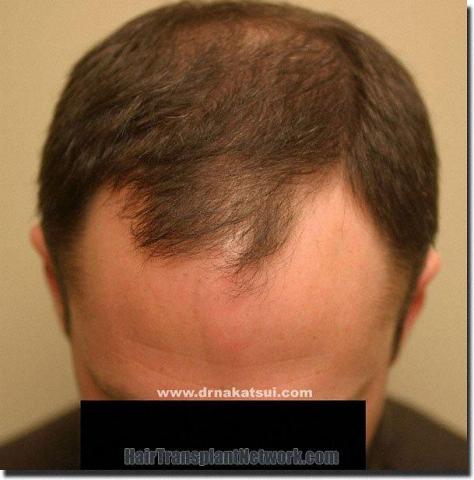 Hair restoration procedure results