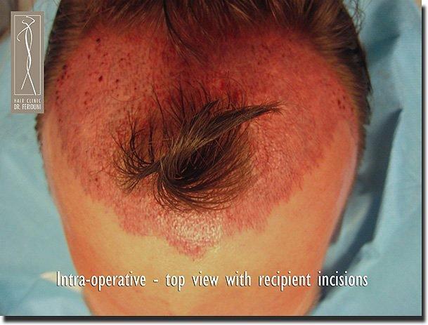 Hair restoration procedure results