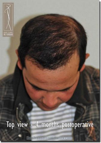 Hair restoration procedure results