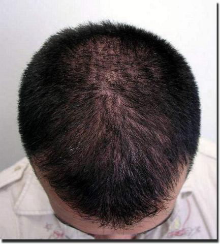 Hair restoration procedure results