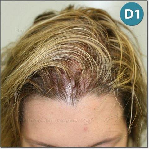 Female Hair loss Treatment and Solutions