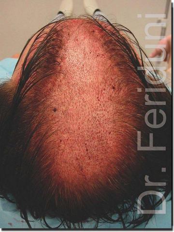 Hair restoration procedure results