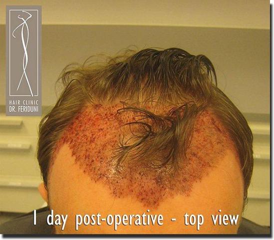 Hair restoration procedure results