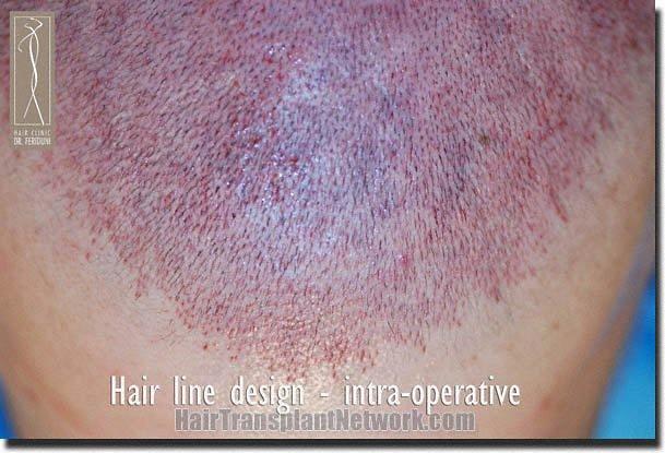 Hair restoration procedure results