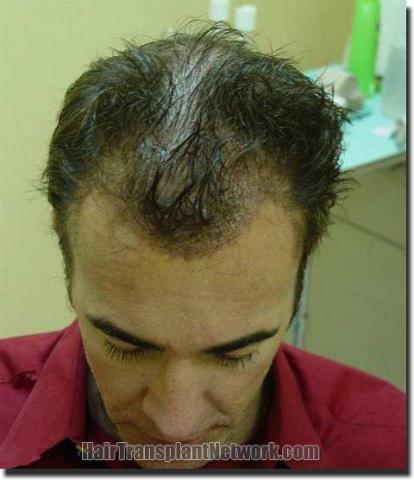 Hair restoration procedure results