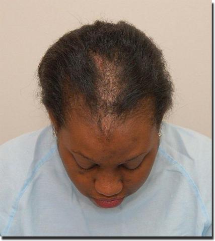 Hair restoration procedure results