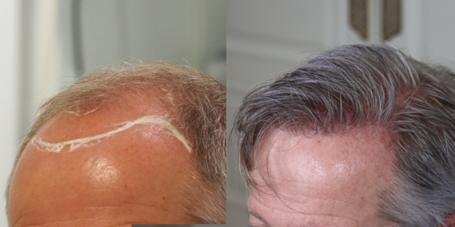 Left side before and after hair transplant