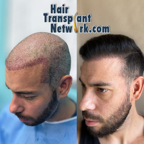 How To Choose The Right Hair Transplant Surgeon