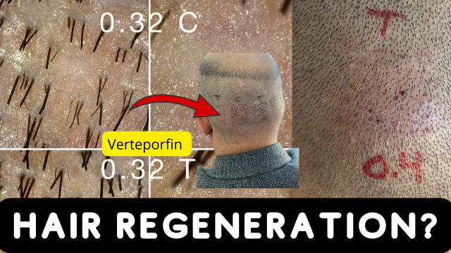 How Can Verteporfin Change The Hair Loss Industry?