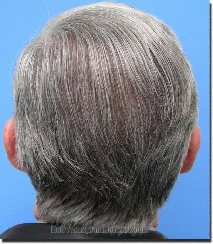 Hair restoration procedure results