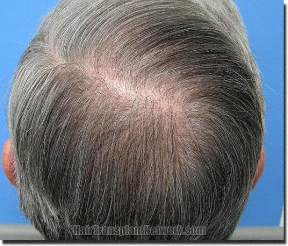 Hair restoration procedure results