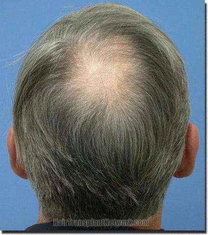 Hair restoration procedure results