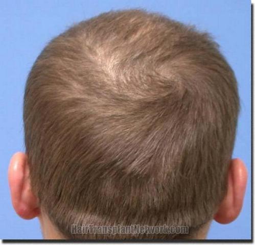 Hair restoration procedure results