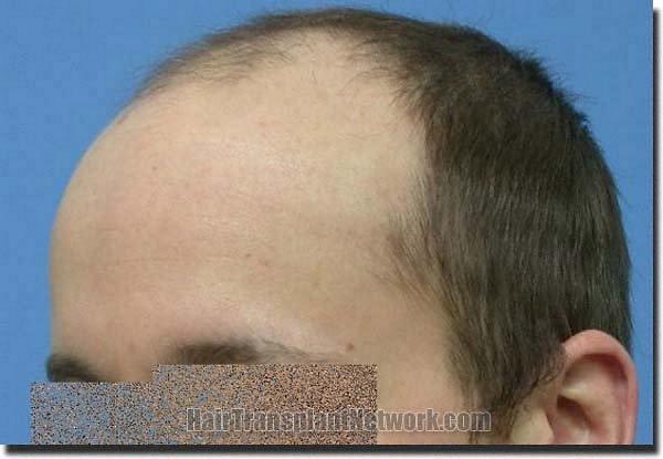 Hair restoration procedure results