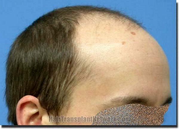 Hair restoration procedure results