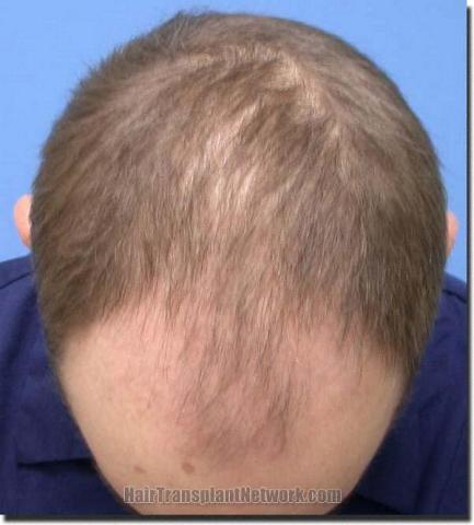 Hair restoration procedure results