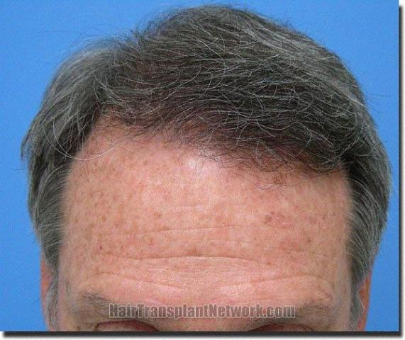 Hair restoration procedure results