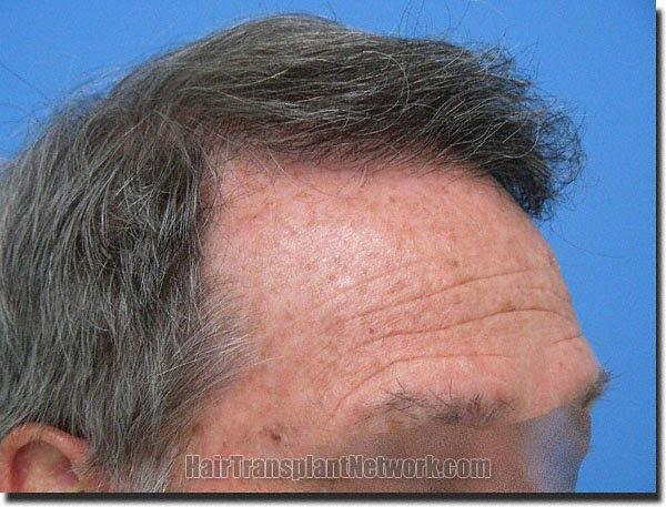 Hair restoration procedure results