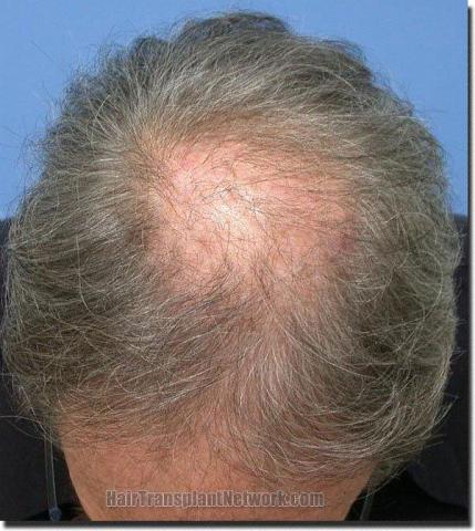 Hair restoration procedure results