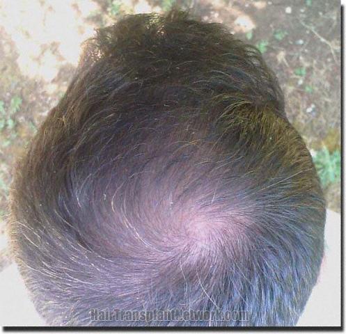 Hair restoration procedure results