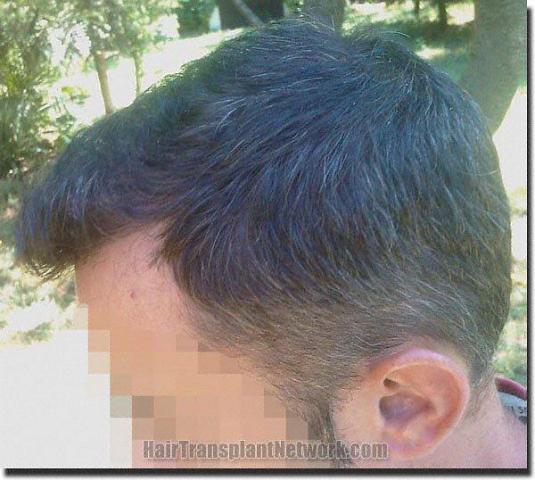 Hair restoration procedure results