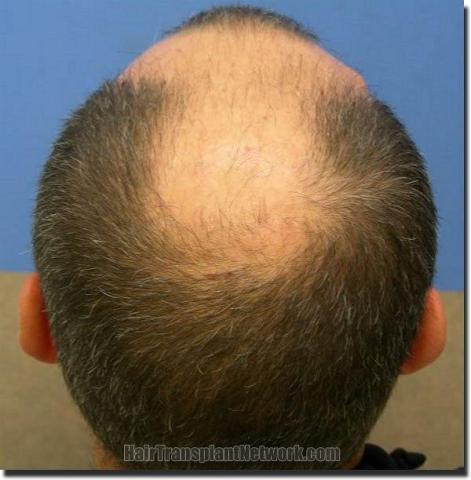 Hair restoration procedure results