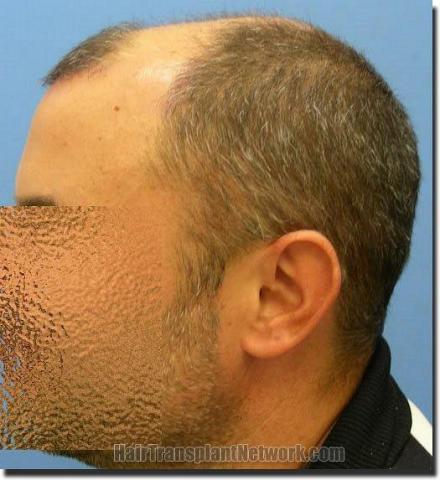 Hair restoration procedure results