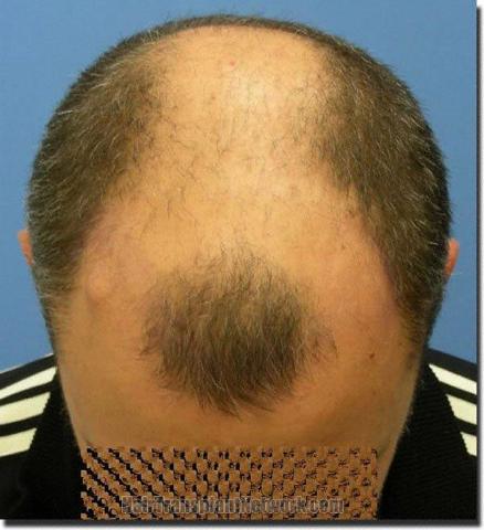 Hair restoration procedure results