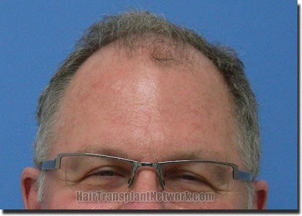 Hair restoration procedure results