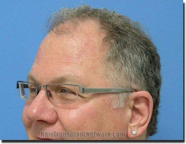 Hair restoration procedure results