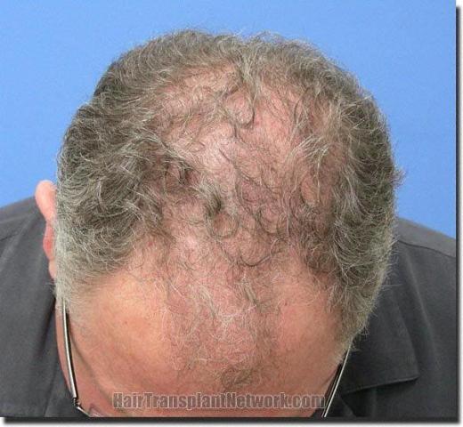 Hair restoration procedure results