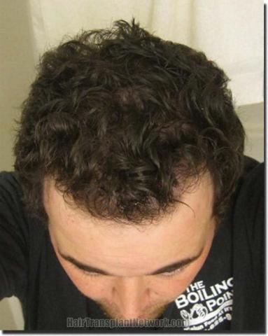 Hair restoration procedure results