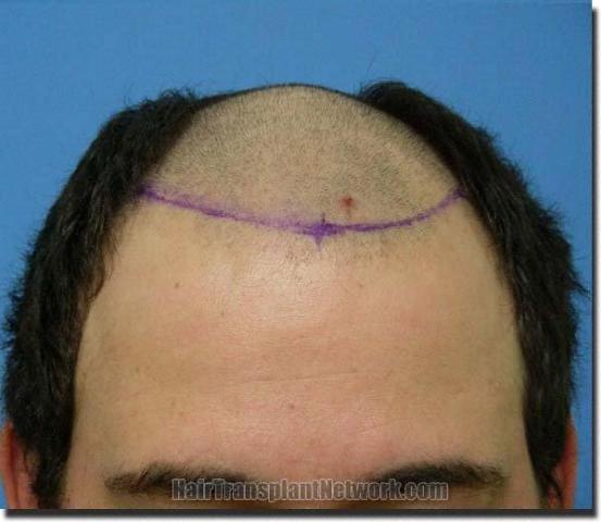 Hair restoration procedure results