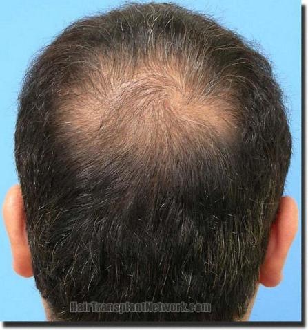 Hair restoration procedure results