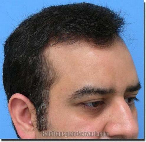 Hair restoration procedure results