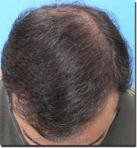 Hair restoration procedure results